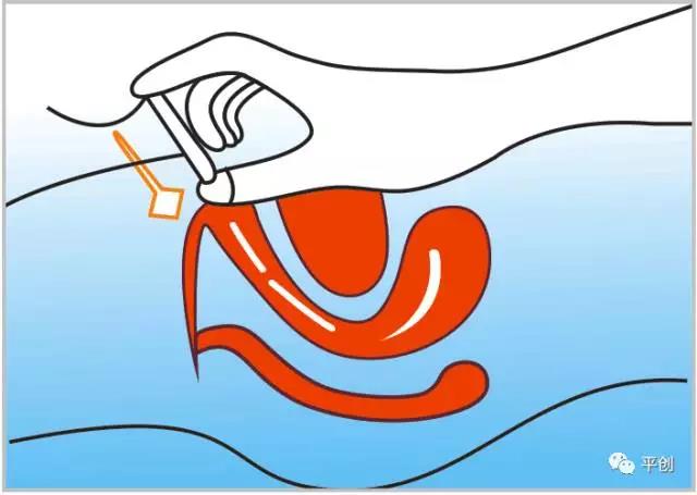 陰道填塞使用圖1