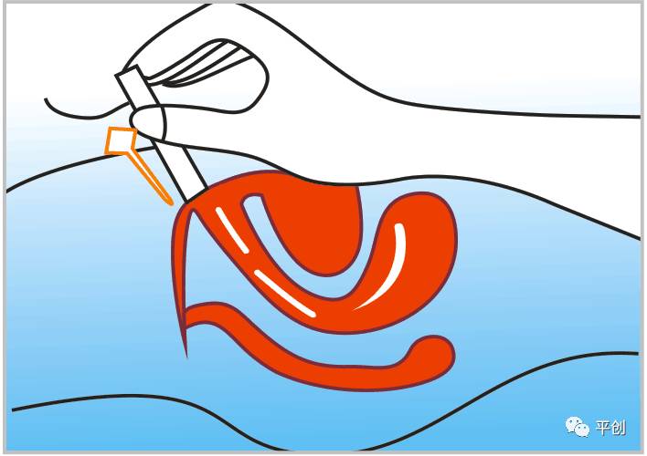 陰道填塞使用圖3